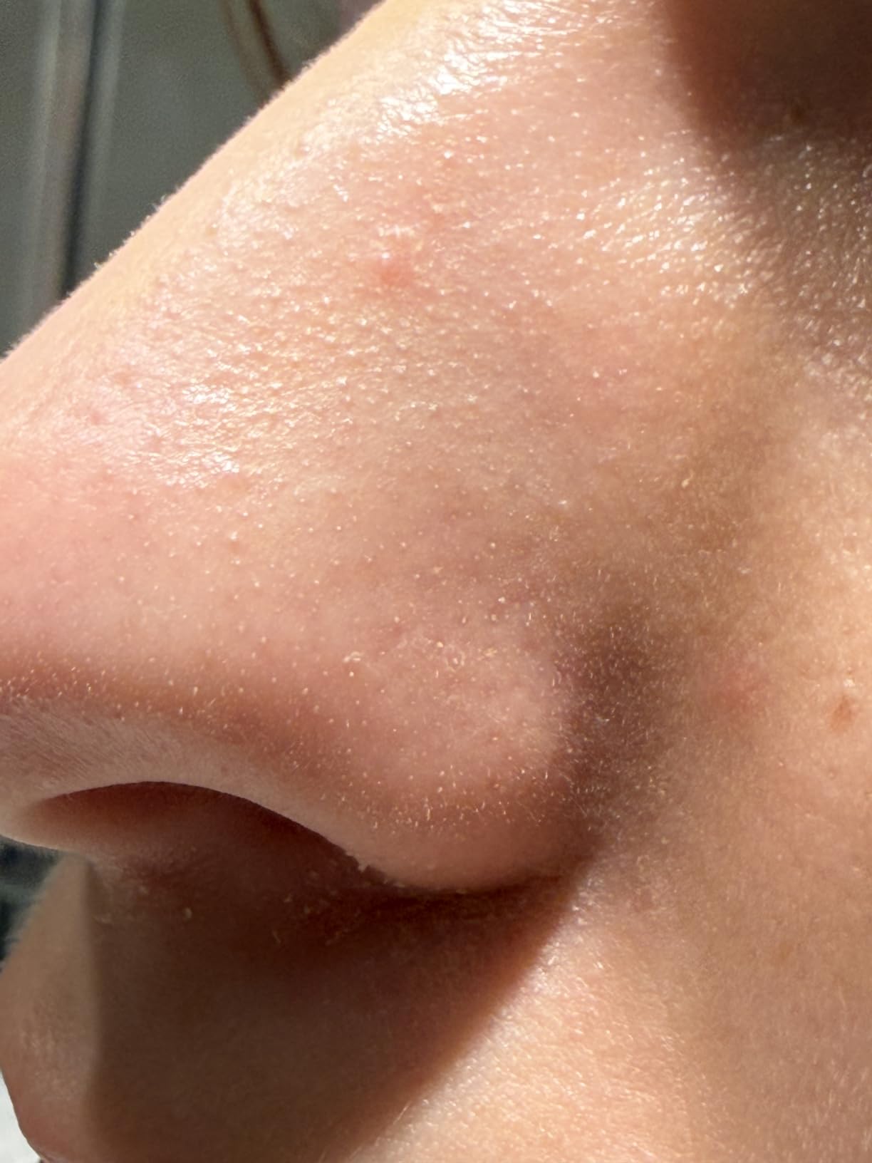 Pores resserrés